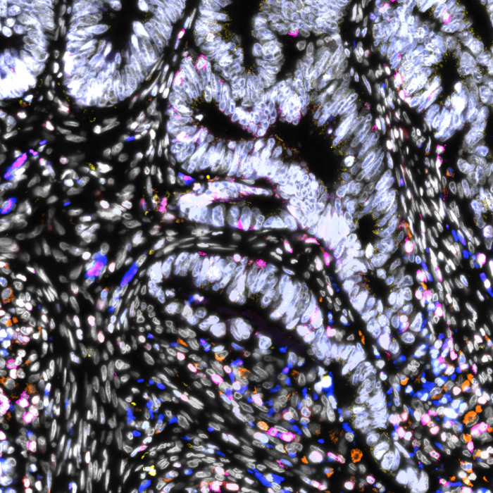 DAPI Ki67 CD8 CD3 CD68 PARP A multiplexed image of colorectal core sample (human FFPE).