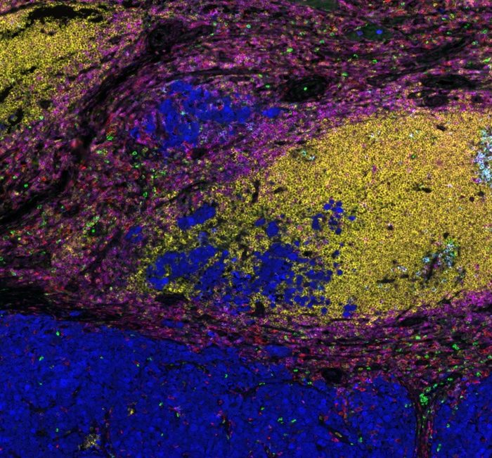 Development of a multiplex assay for prediction of immunotherapy response in metastatic melanoma patients