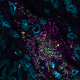 Exploring spatial insights between tumor and stroma with multiplex immunofluorescence