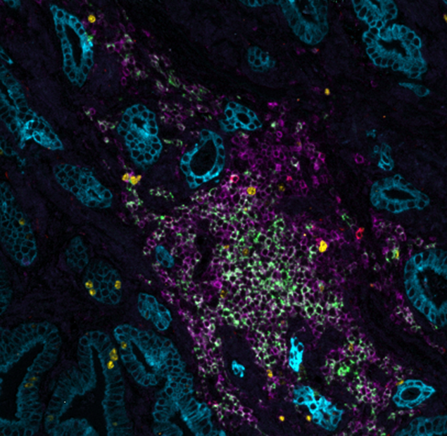 Blog: Exploring spatial insights between tumor and stroma with multiplex immunofluorescence